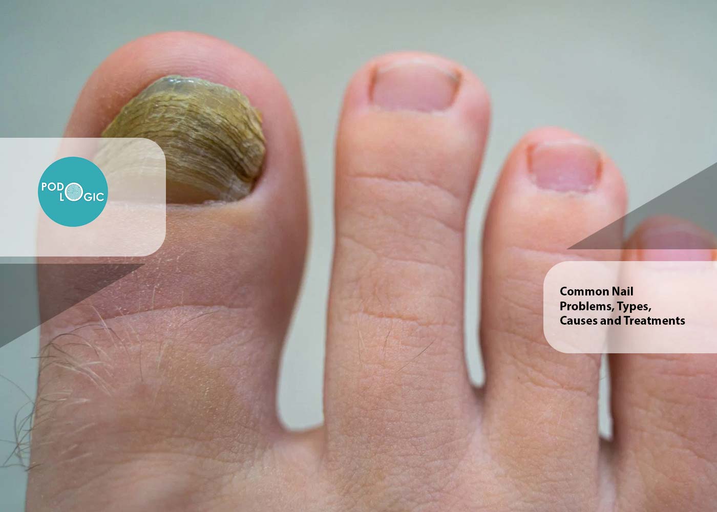 Common Nail Problems, Types, Causes and Treatments