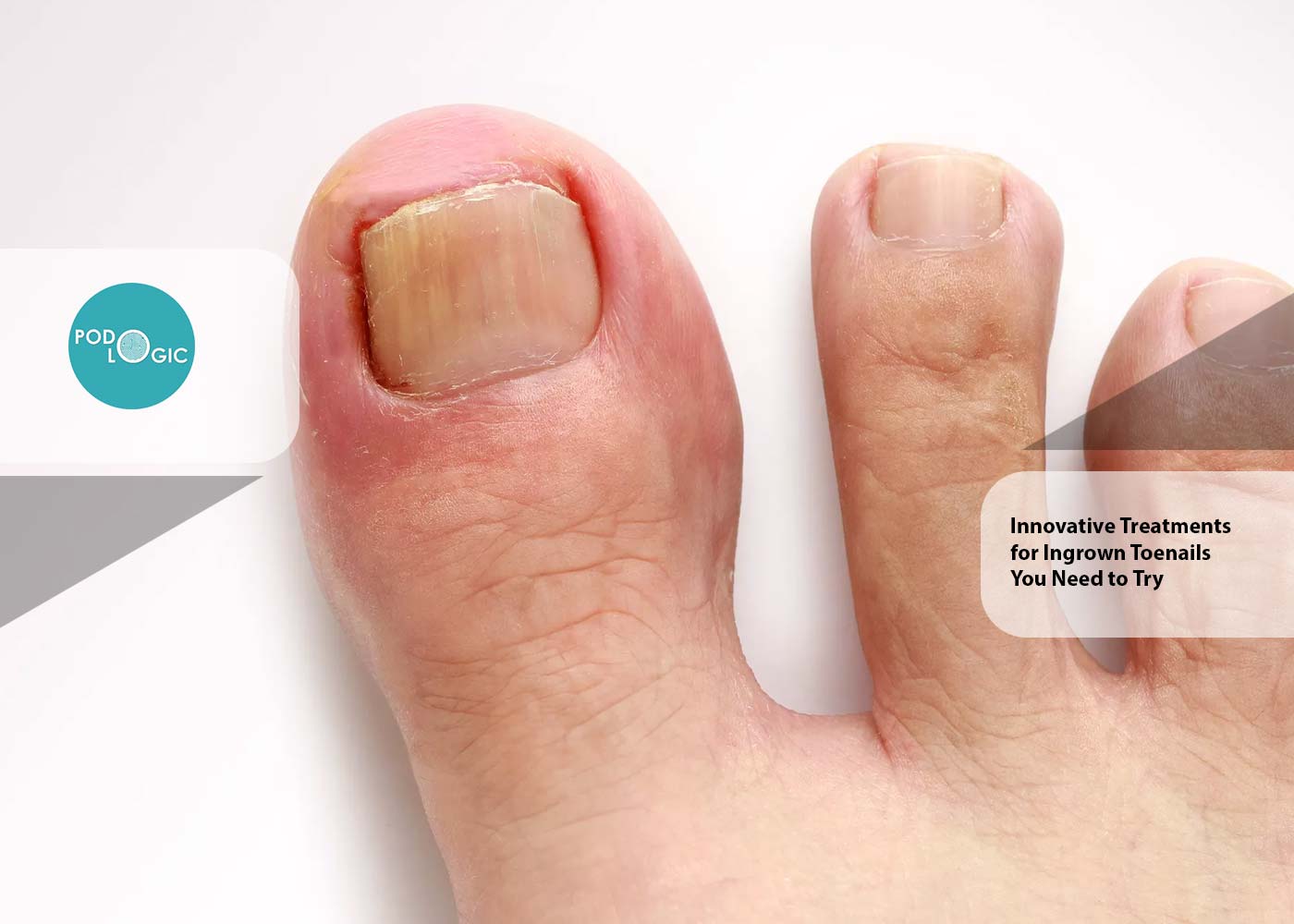Innovative Treatments for Ingrown Toenails You Need to Try